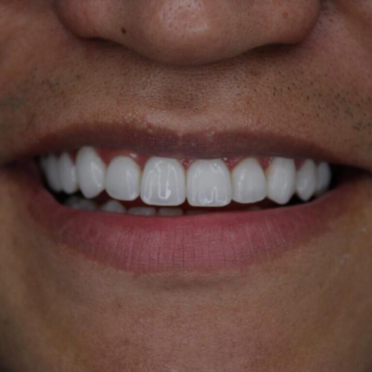 Estética Dental petrolina pe